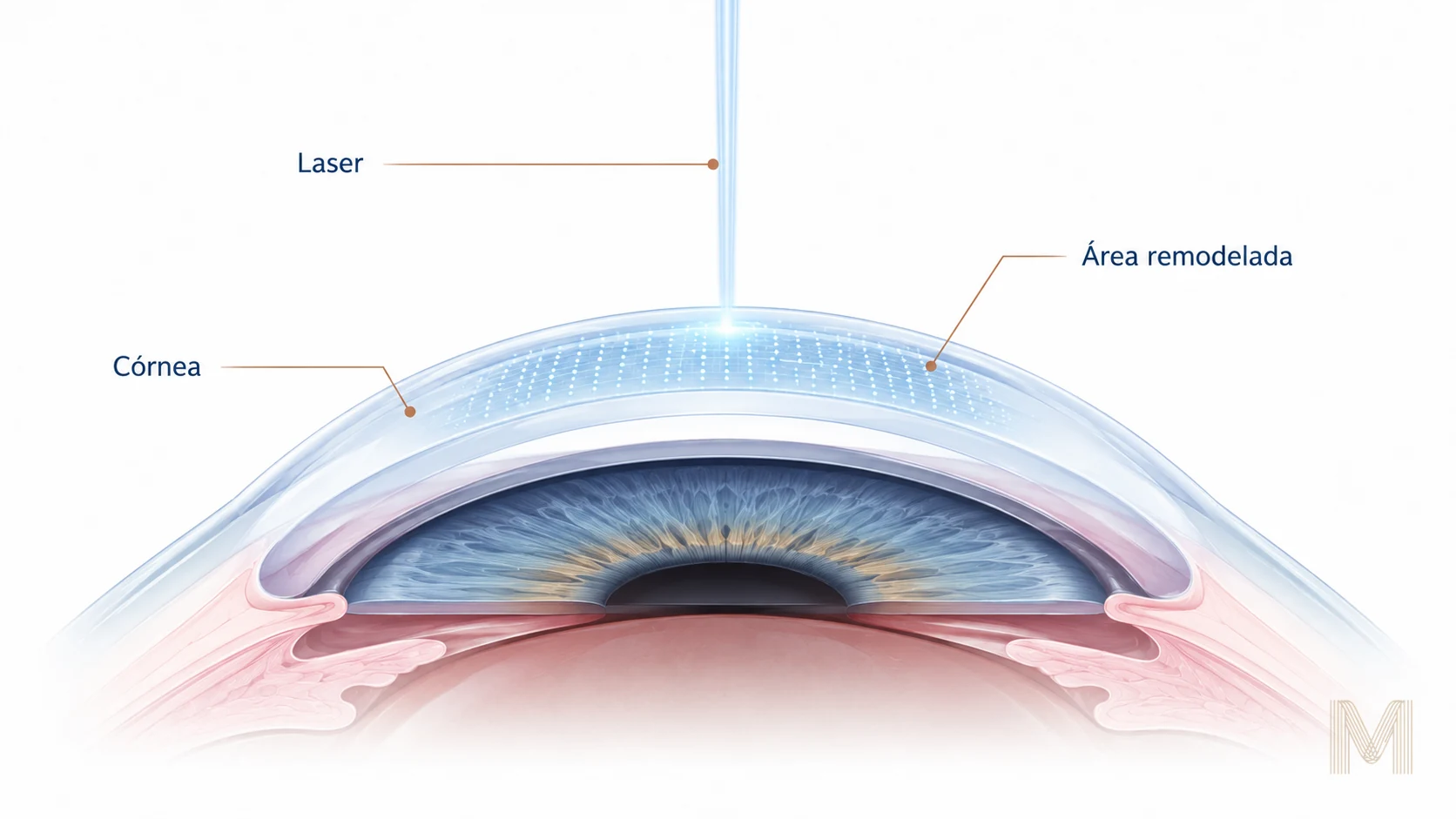 Diagrama ilustrando a ação do laser excimer sobre o estroma corneano durante cirurgia refrativa